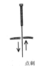 火针疗法的进针方法