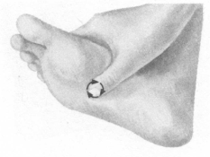 糖尿病按摩部位图解