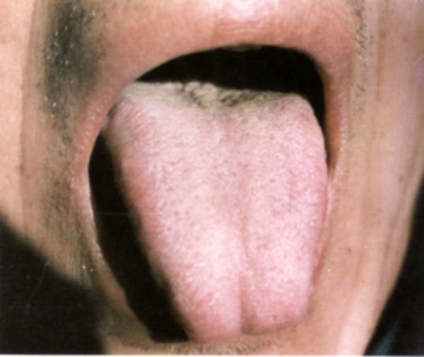 淡红舌白滑根灰苔