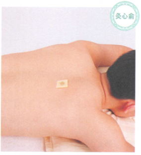 慢性支气管炎艾灸哪个部位图解