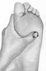 胃肠炎按摩部位图解