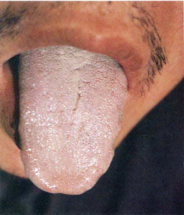 淡红舌尖白根黄苔1