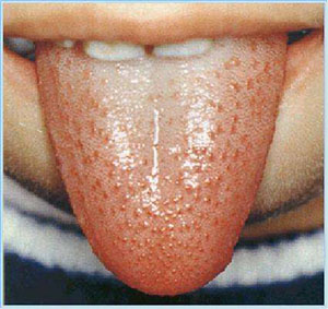 几种异常舌苔预示疾病