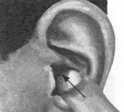 咽喉炎按摩部位图解