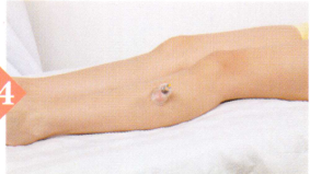 急性阑尾炎拔罐部位图解