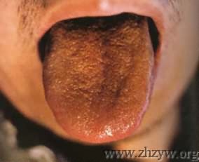 暗红舌焦黄燥裂苔