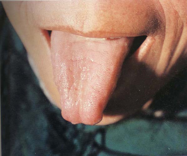 淡红舌薄白滑润苔