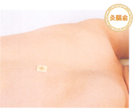 呃逆艾灸哪个部位图解