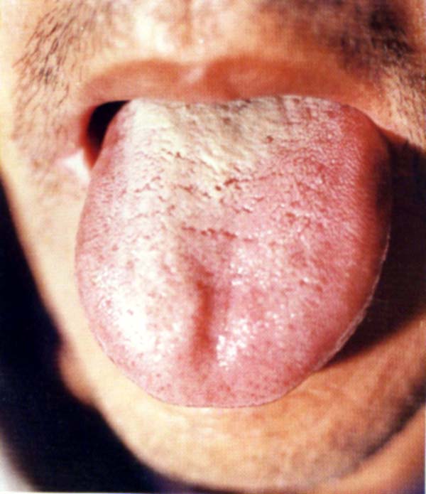 淡红舌偏白腻苔1