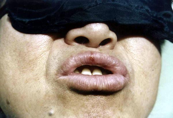 中医望皮肤之疱疹,破溃(唇风)