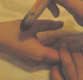 防治青春痘艾灸哪个部位图解