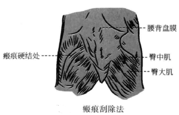 小针刀的运刀方法