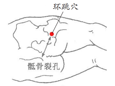 以哑门、扶突、环跳穴为主穴，针刺治疗中风后遗症