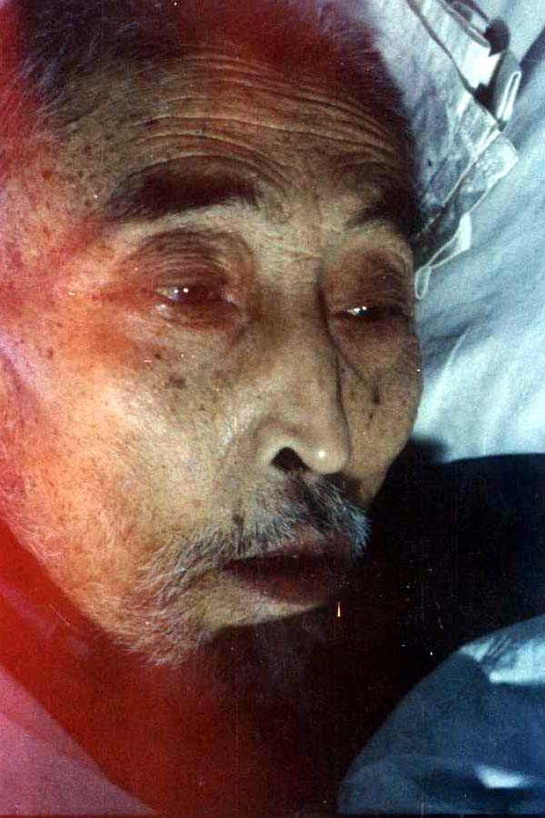 中医望目之目窠内陷