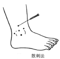 火针疗法的进针方法