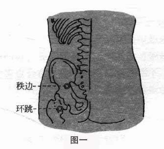 梨状肌综合征钩针疗法