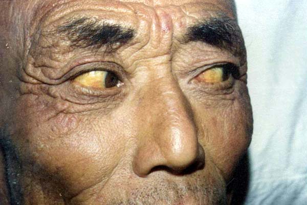 中医望神之面色红黄，阳黄