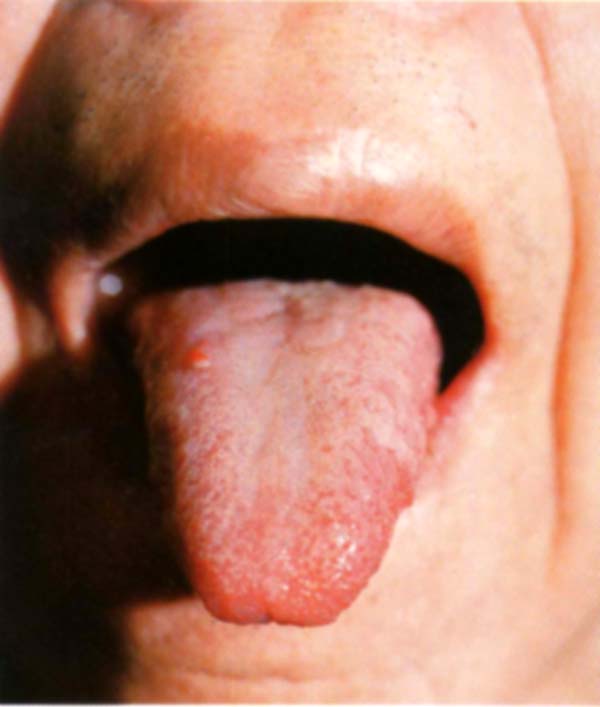 舌疔2