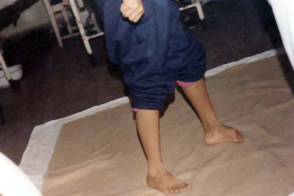 中医望肢体之足内翻