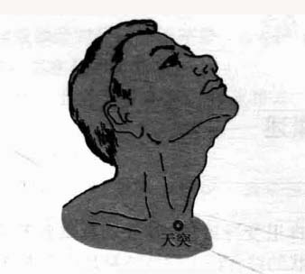 支气管哮喘钩针疗法