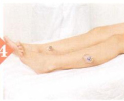 中风后遗症拔罐部位图解