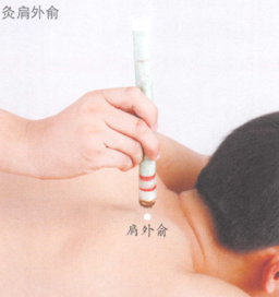 落枕艾灸哪个部位图解