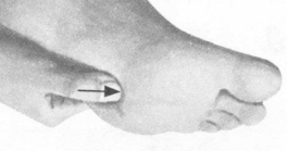 腰椎间盘突出症按摩部位图解