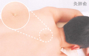 痤疮艾灸哪个部位图解