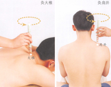 落枕艾灸哪个部位图解