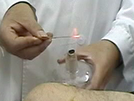 器具技法--火针