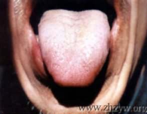 淡红苍老舌白厚腻苔