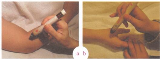 小儿长痱子艾灸哪个部位图解