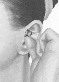 肥胖症按摩部位图解