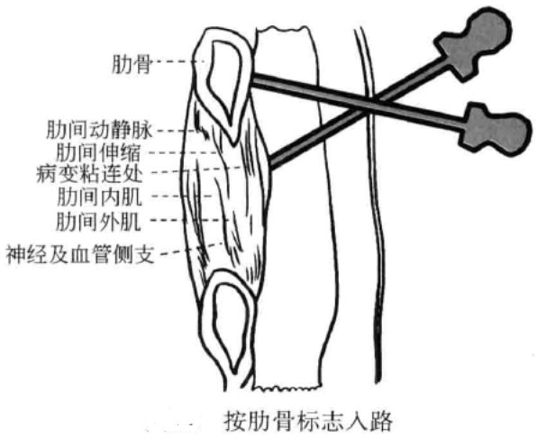 小针刀操作手术入路