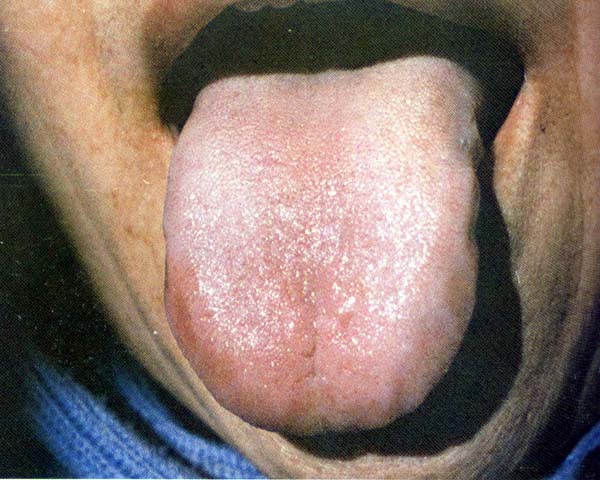 淡红瘀斑舌薄白干苔