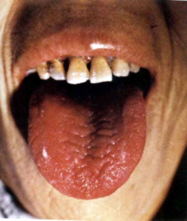 绛色褶纹无苔舌