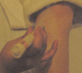 防治青春痘艾灸哪个部位图解