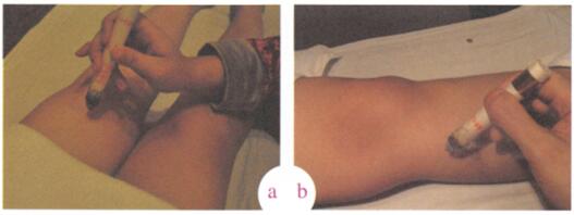 祛除雀斑艾灸哪个部位图解