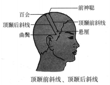 飞针技术顶区刺激线