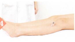 子宫脱垂拔罐部位图解