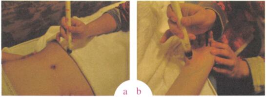 更年期综合征艾灸哪个部位图解