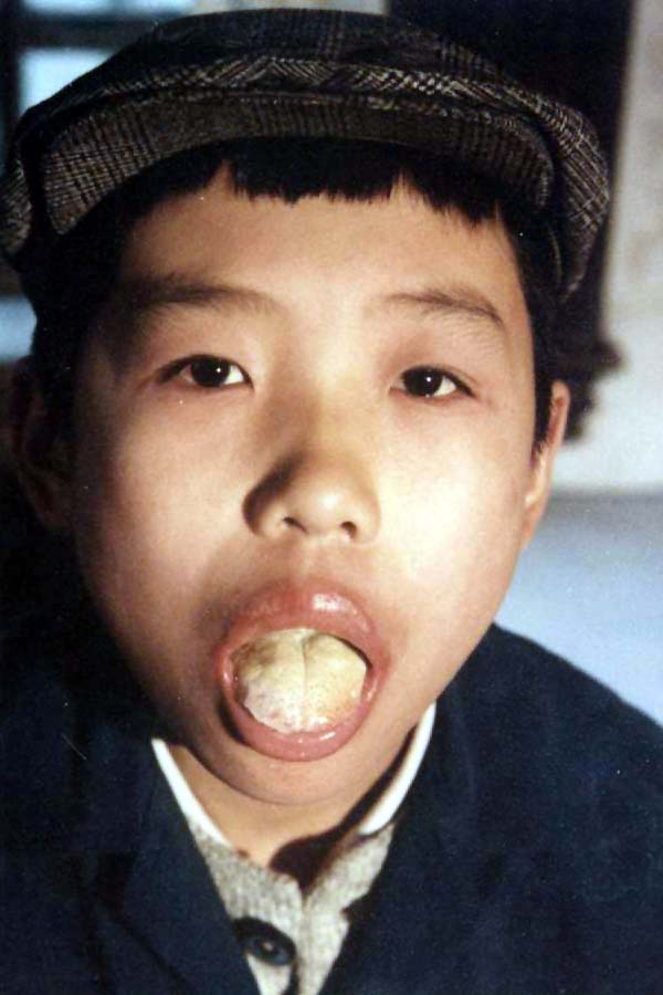 中医望口与唇之唇舌红肿