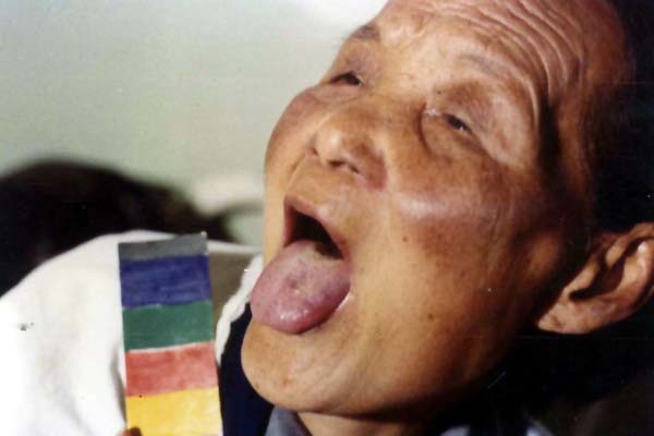 中医望目之睑眩赤烂