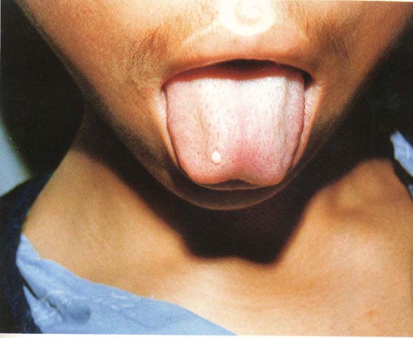 舌疔1