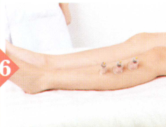 呕吐拔罐部位图解