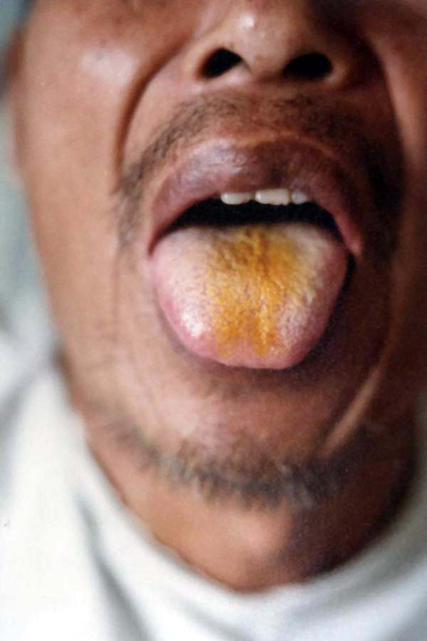 中医望口与唇之唇黑