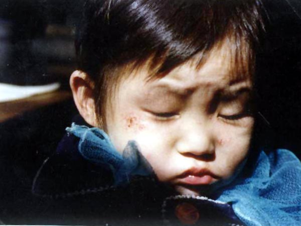 中医望皮肤之旋耳疮（奶疮）