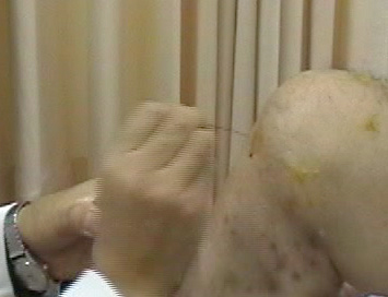 器具技法--火针