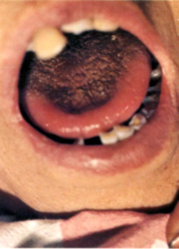 红嫩强硬舌霉酱苔