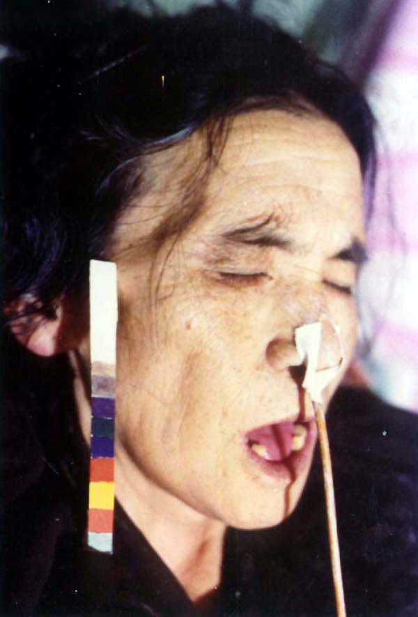 中医望色之面色淡白，舌红光莹